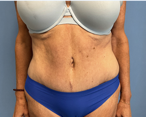 Tummy-Tuck--Case-Study-7318 | After Body
